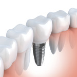 Implanty dentystyczne Bemowo